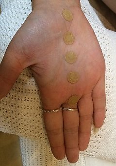 Adjunct & Non-Invasive Options. acupuncture witney oxfordshire KHT hand patches smaller