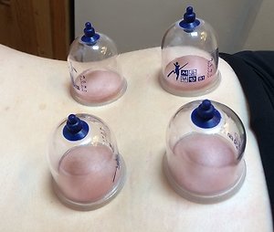Adjunct & Non-Invasive Options. acupuncture witney oxfordshire cupping
