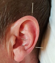 Adjunct & Non-Invasive Options. acupuncture witney oxfordshire ear smaller